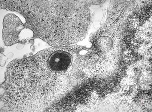 F,21y. | bone marrow - sideroblastic anemia F,21y. | bone marrow - sideroblastic anemia